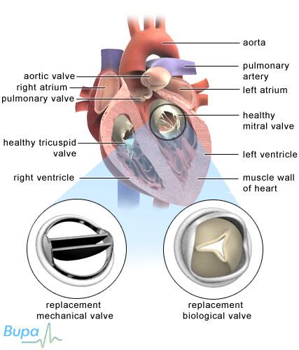 life after aortic valve replacement with mechanical