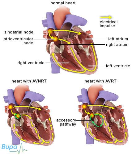 Supraventricular tachycardia (SVT)