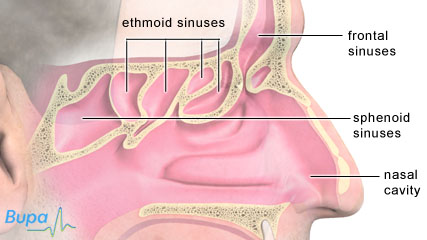 maxillary and ethmoid sinus disease